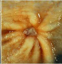 gastric ulcer stress